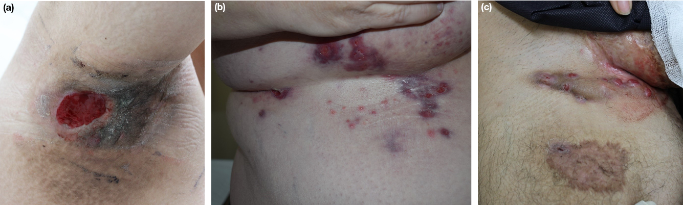Scarring and tract healing after laser hair removal : r/Hidradenitis