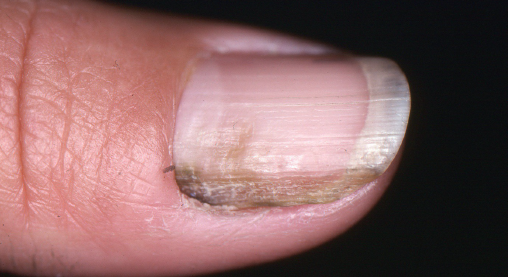 The Journal of Pediatrics - A 9-year-old girl was diagnosed with isolated  nail lichen planus based on findings of nail plate thinning, longitudinal  ridging, distal splitting, and dorsal pterygium involving the fingernails.