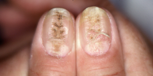 PPT - Nail Disorders PowerPoint Presentation, free download - ID:1135747