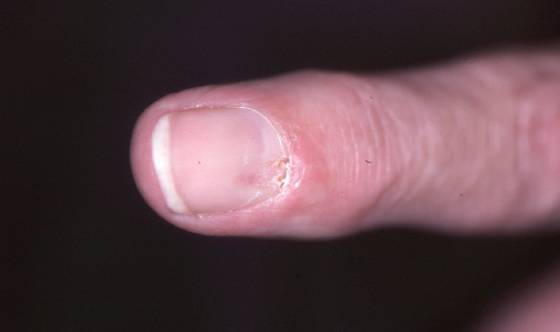 Some sort of infection in my nails/cuticles, please help | Salon Geek -  Salon Professionals Forum
