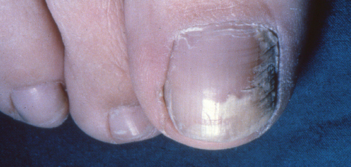 Disorders of the Nail Apparatus - Fitzpatrick's Color Atlas and Synopsis of  Clinical Dermatology, Seventh Edition